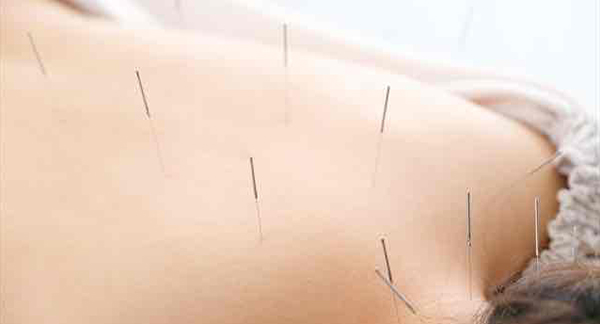 鍼灸
